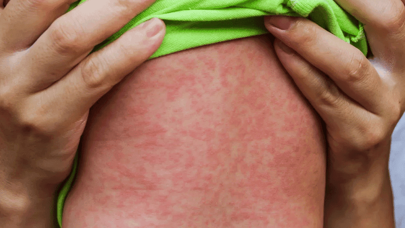 সারাদেশে হাম ও উপসর্গে আরও ৫ শিশুর মৃত্যু