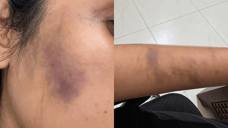 বনশ্রীতে কুকুরকে খাবার দেওয়ায় তরুণীকে মারধরের অভিযোগ