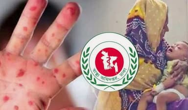 হাম উপসর্গ নিয়ে আরও ৩ শিশুর মৃত্যু
