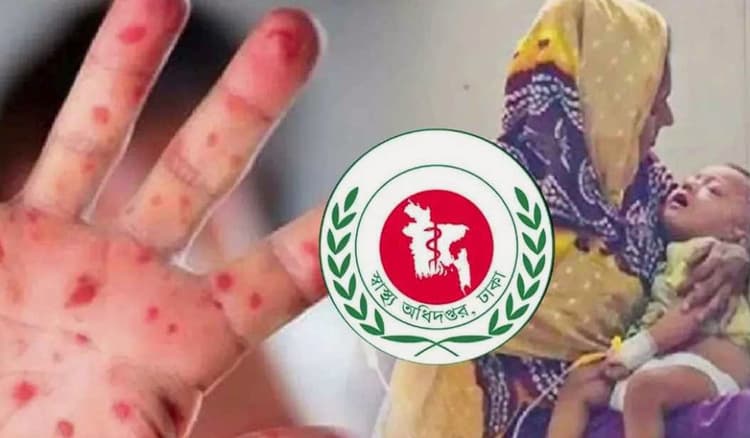 হামের উপসর্গ নিয়ে ২৪ ঘণ্টায় ৭ শিশুর মৃত্যু, প্রাণহানি বেড়ে  ৯১৫