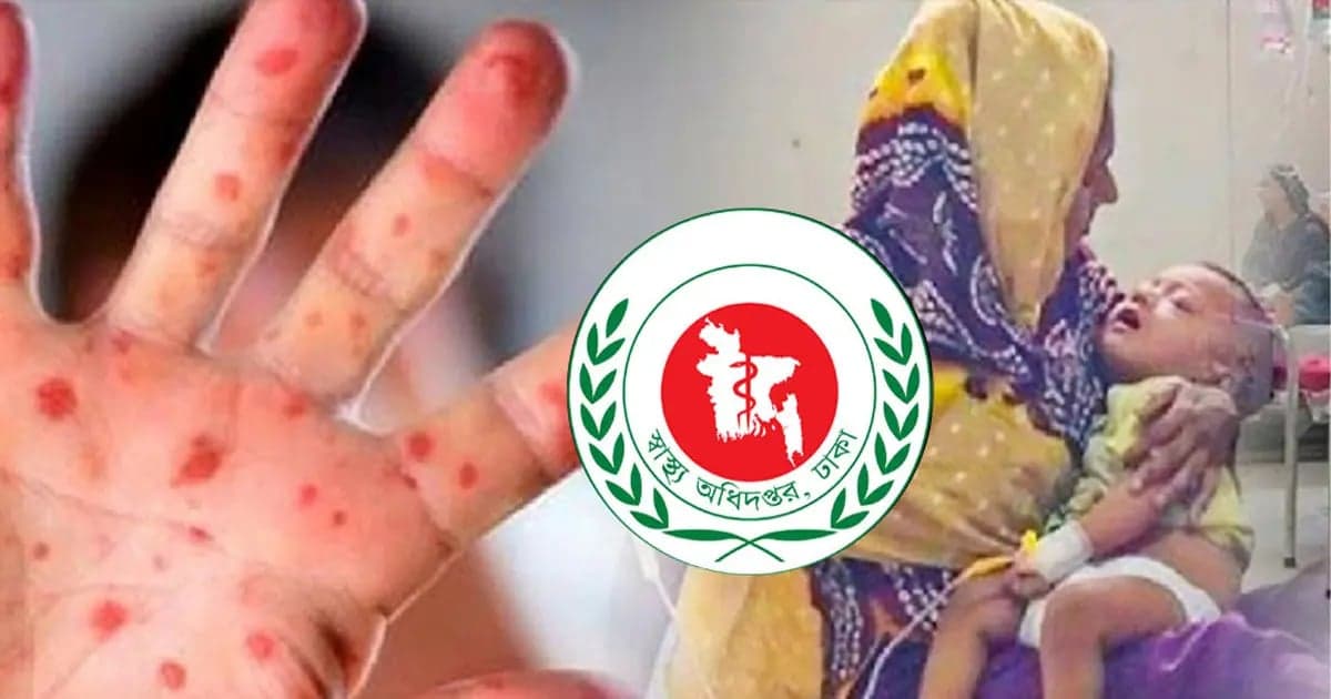 সিলেটে হামের উপসর্গে আরও ২ শিশুর মৃত্যু, হাসপাতালে ভর্তি ৩৩৬