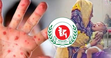 ২৪ ঘণ্টায় হাম ও উপসর্গে ৯ জনের মৃত্যু, বাড়ছে সংক্রমণ