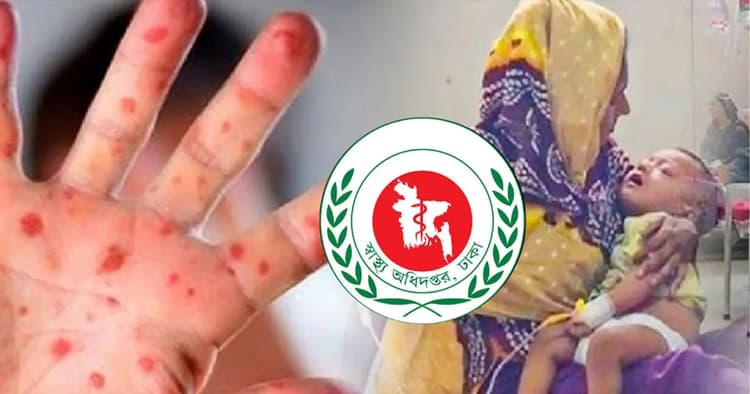সিলেটে হামের উপসর্গে আরও ২ শিশুর মৃত্যু, হাসপাতালে ভর্তি ৩৩৬