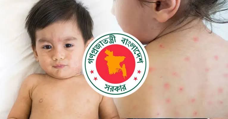 হামের উপসর্গে আরও ৫ শিশুর মৃত্যু, একদিনে আক্রান্ত ১,০৮৩