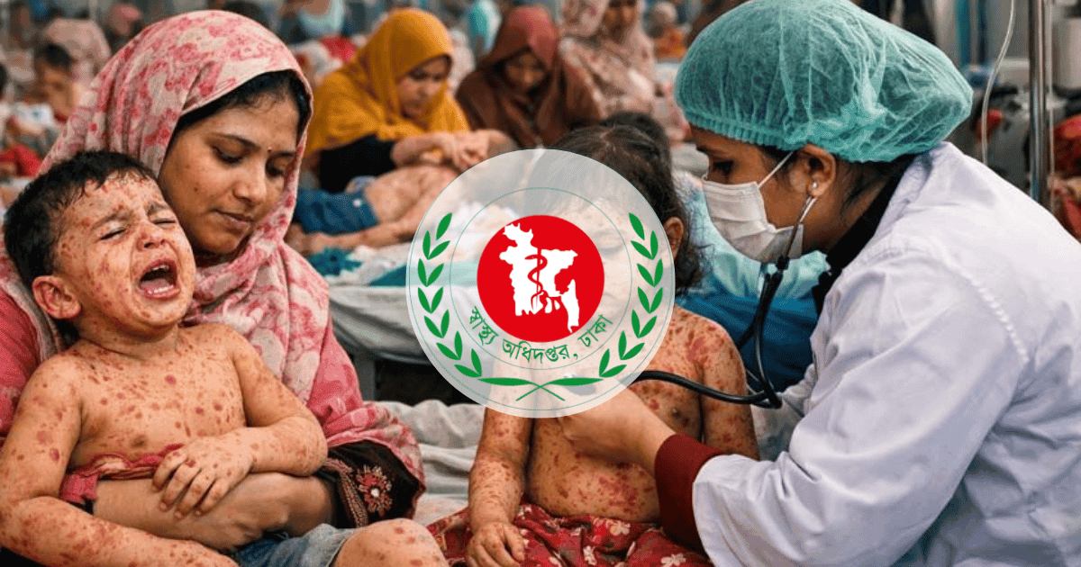 হাম উপসর্গে আরও ৫ শিশুর মৃত্যু, মোট প্রাণহানি ১,০৮১