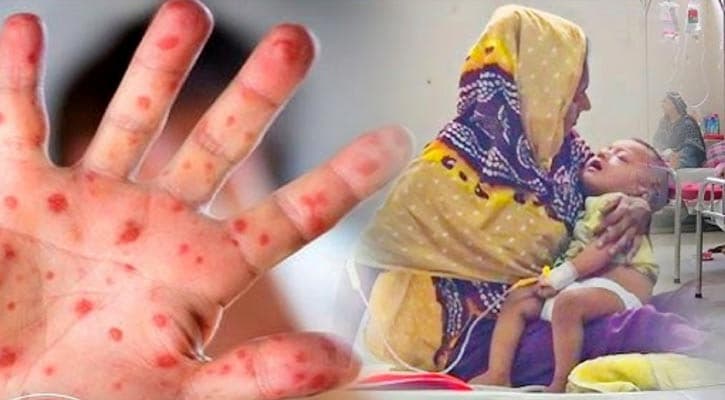 হামের উপসর্গে আরও ৬ শিশুর মৃত্যু, প্রাণহানি বেড়ে ৯০৮