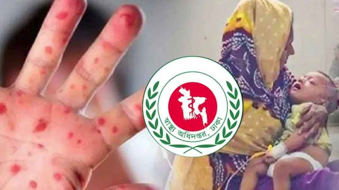 হাম ও হামের উপসর্গে আরও ১৬ শিশুর মৃত্যু