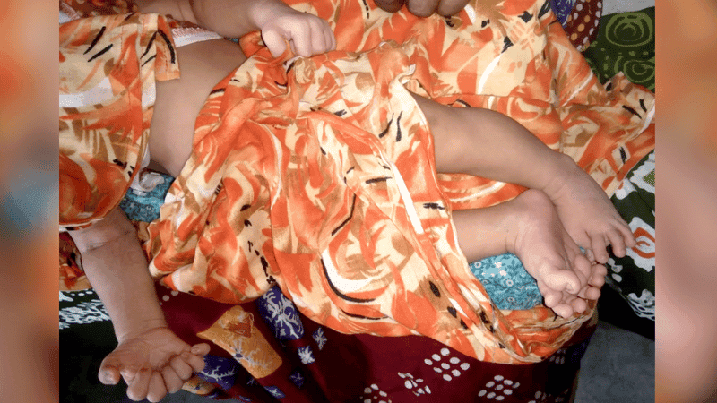 ২৮ আঙুল নিয়ে নবজাতকের জন্ম