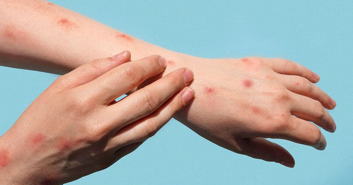 এমপক্স নতুন কোভিড নয়: বিশ্ব স্বাস্থ্য সংস্থা