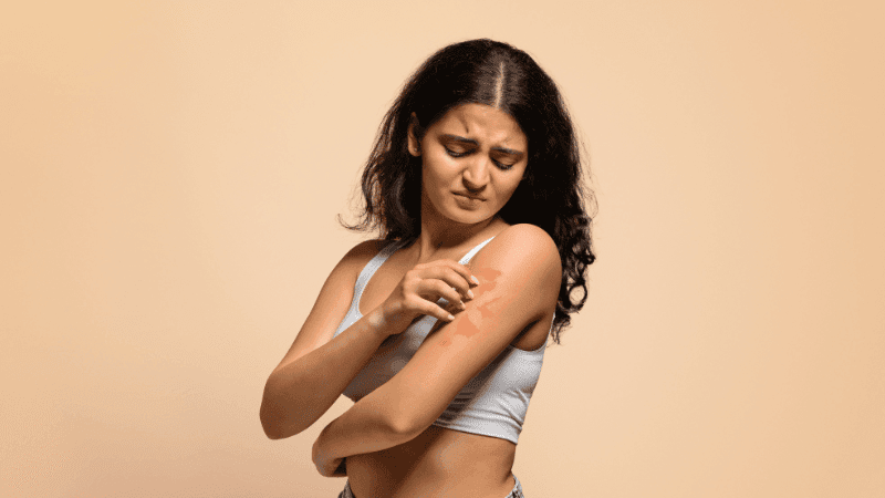 চুলকানি কমেছে মানেই সেরে যায়নি; বর্ষায় ছত্রাকের ফাঁদ থেকে রক্ষার উপায়