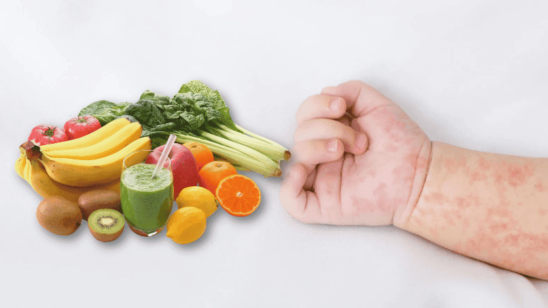 শিশুর হাম হলে যেসব খাবার খাওয়াবেন, যেসব খাওয়াবেন না