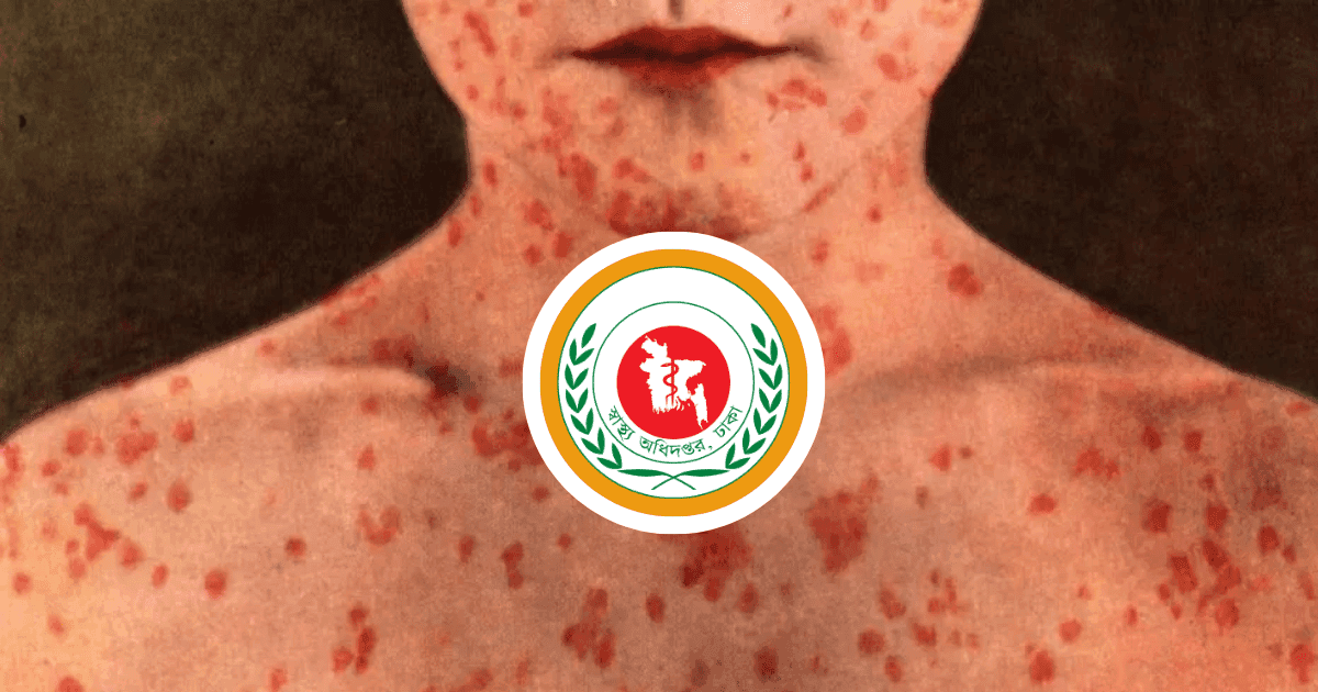 হাম উপসর্গে আরও ৪ মৃত্যু, নতুন রোগী ১,৩৪৯