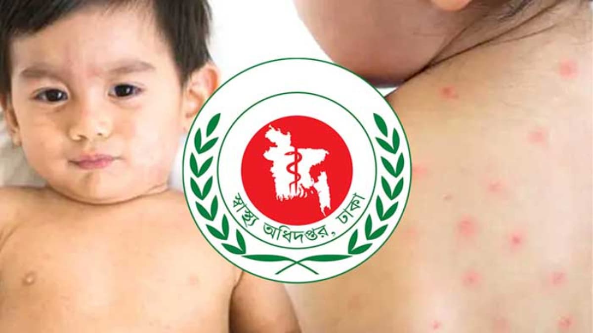 হাম ও হামের উপসর্গে আরও ছয় শিশুর মৃত্যু